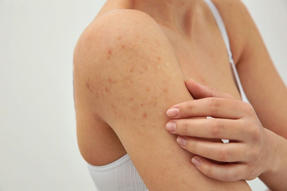 how-to-remove-under-the-skin-pimples-without-damaging-your-skin-in-2020